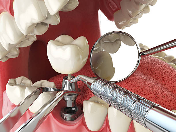 Best Emergency Wisdom Tooth Extraction in Archer Lodge, NC